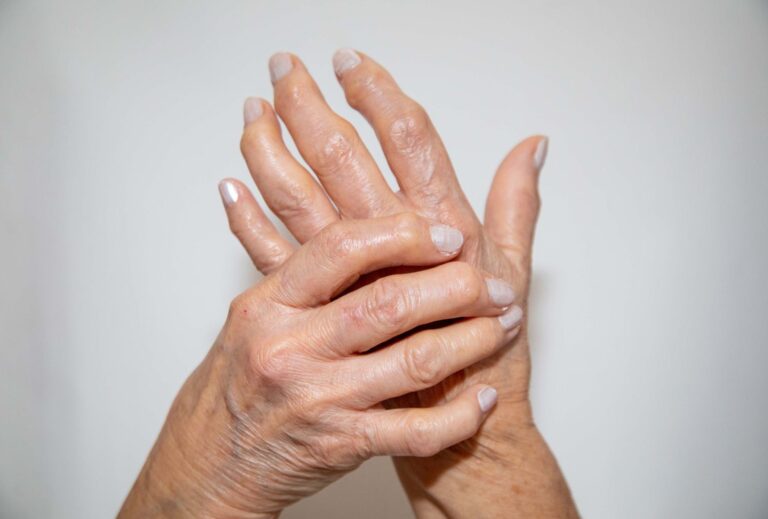 What Are The 4 Stages Of Rheumatoid Arthritis?