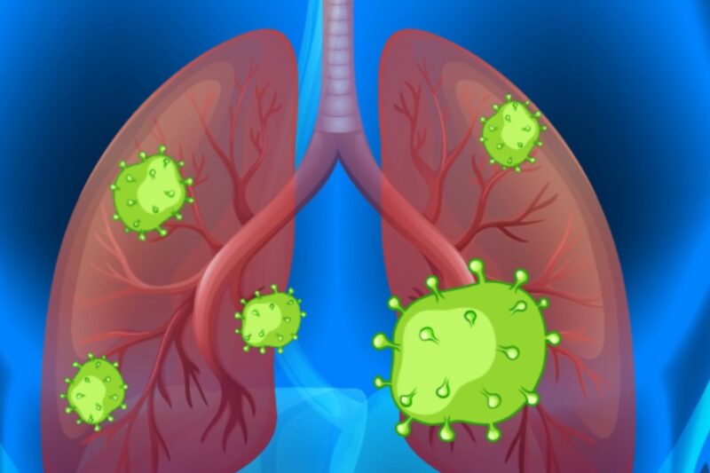 Infections In Chest 10 Best Natural Cures for Chest Infection: Effective Home Remedies ...